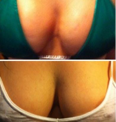 Vampire Breast Lift® Before & After Photos