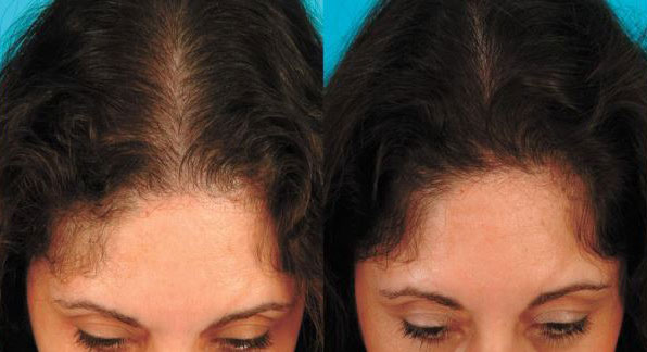 hair-restoration-girls - Anti-Aging Hormones Reno NV