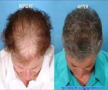 hair-restoration - Anti-Aging Hormones Reno NV