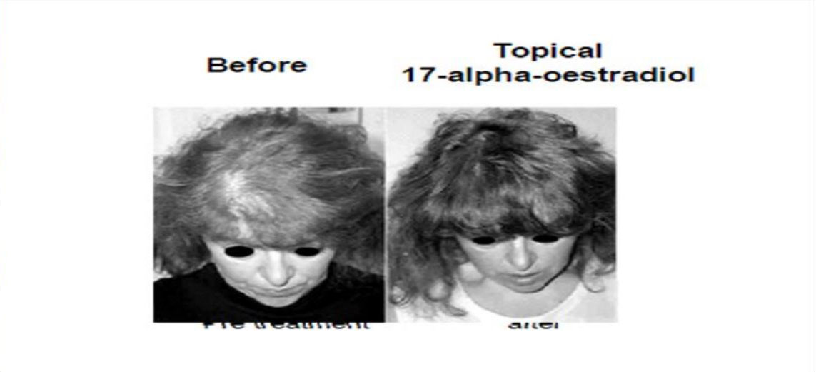 hair-loss - Anti-Aging Hormones Reno NV