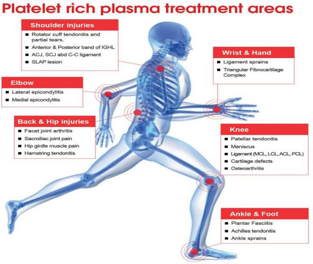 platelet-rich-plasma-treatment-areas