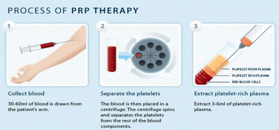 prp-therapy