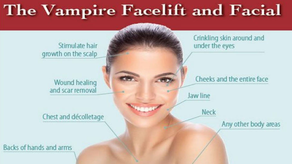 vampire-facelift-and-facial