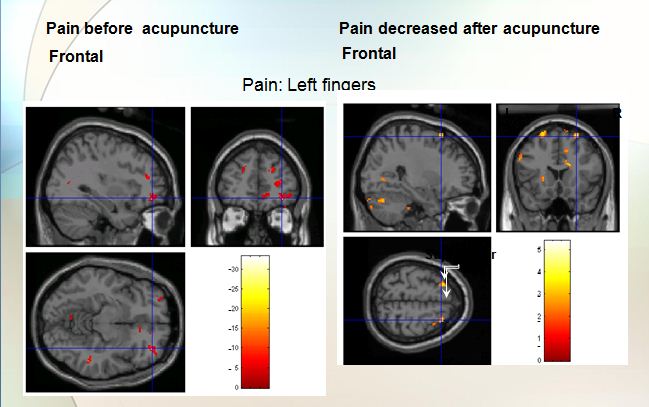 BFA Acupuncture