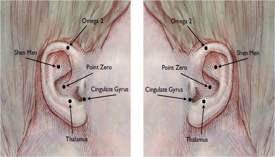 Battlefield Acupuncture Points -  Rapid auriculotherapy technique Reno NV 