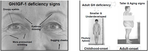 Deficiency Symptoms - Growth Hormone Reno NV