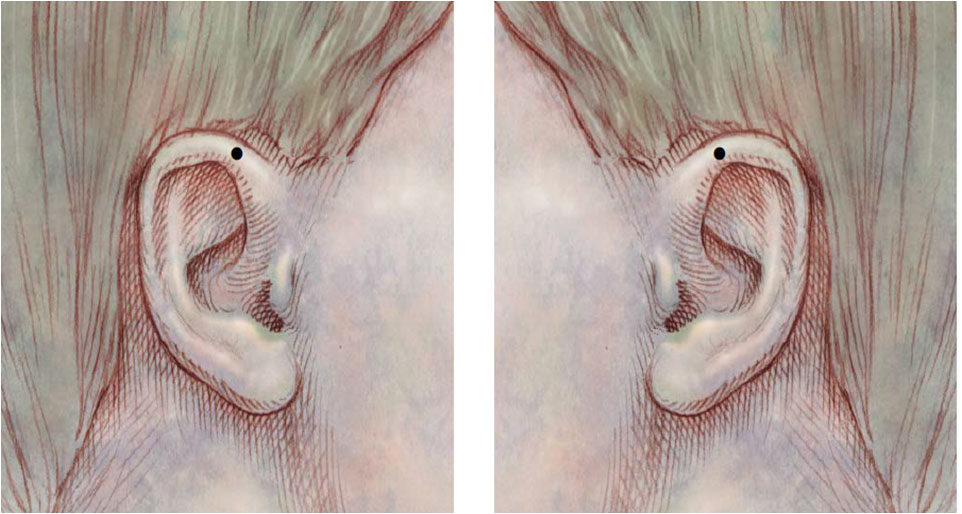 Omega 2 -  Rapid auriculotherapy technique Reno NV  