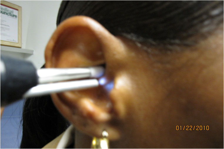 STIMULATION OF THE EARDIFFERENT COLORS DIFFERENT FREQUENCIES -  Rapid auriculotherapy technique Reno NV 