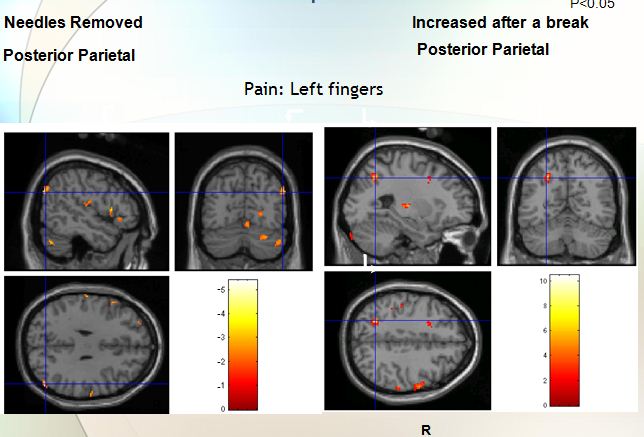 image -  Rapid auriculotherapy technique Reno NV 