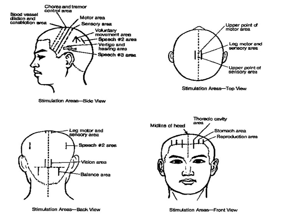 phase-2 -  Rapid auriculotherapy technique Reno NV 