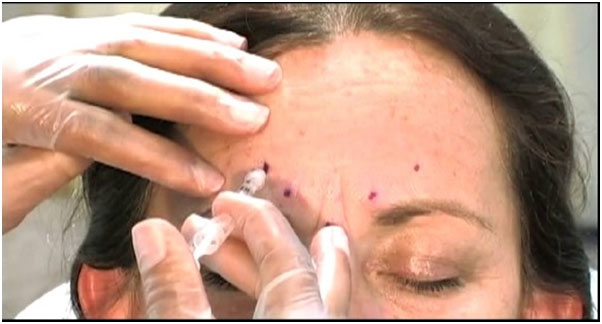 Traditional Administration of Botox Reno