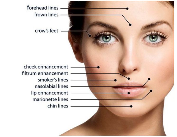 Treatment Areas - Dermal Fillers in Reno NV