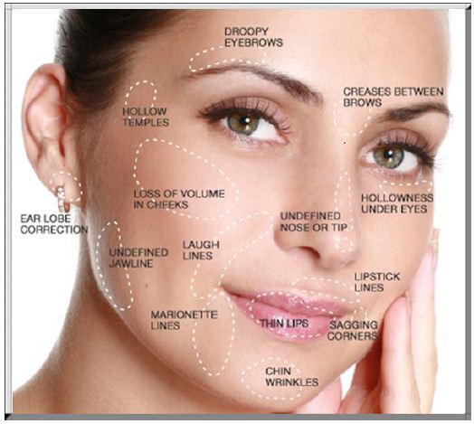 Treatment Areas - Dermal Fillers in Reno NV