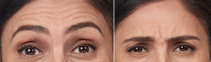 eyes before and after treatment
