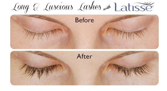 eye lashes - Latisse Treatment in Reno NV