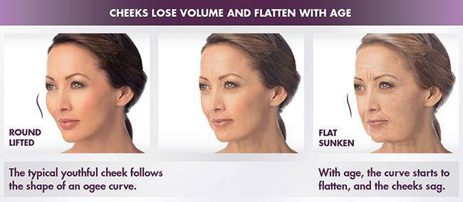 cheek lose volume 3 woman's faces - Dermal Fillers in Reno NV