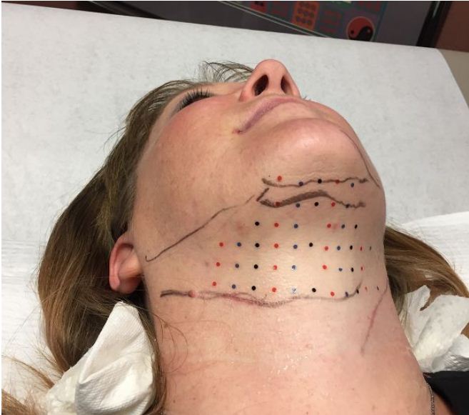 Kybella in Reno  Tighten Skin Under Chin and Jaw