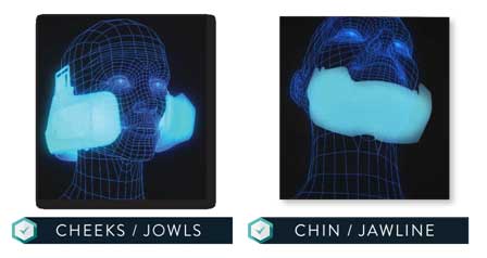 cheeks/ jowls and chin /jawline images in 3d - Evoke in Reno NV