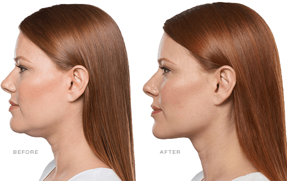 woman's face before and after Kybella - Kybella in Reno NV