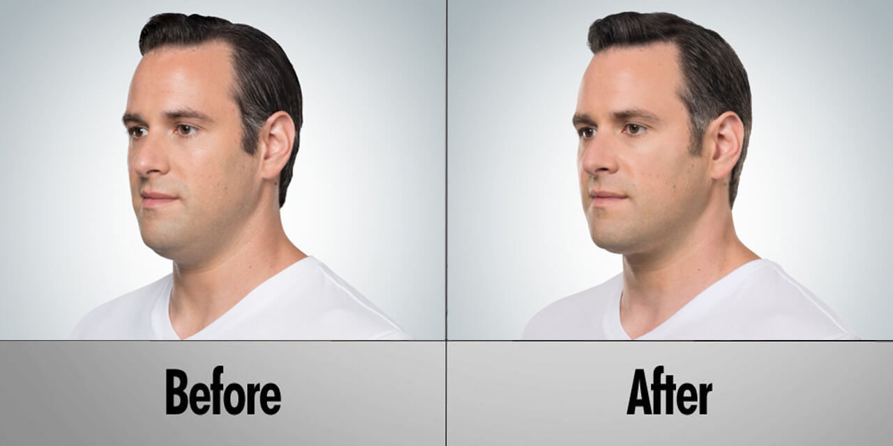 male faces before and after Kybella -  Kybella in Reno NV