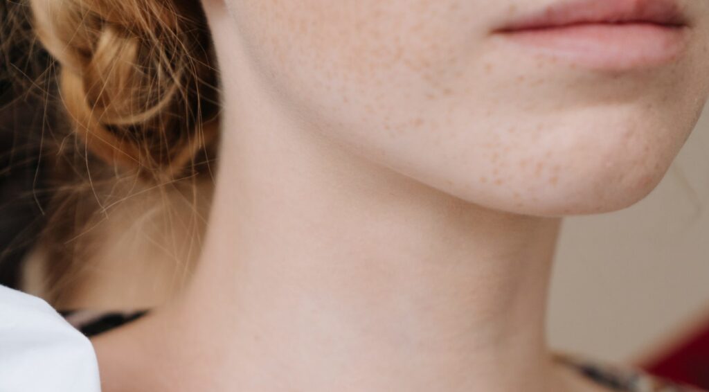 freckled woman jawline right angle - Evoke vs. Kybella Reno NV