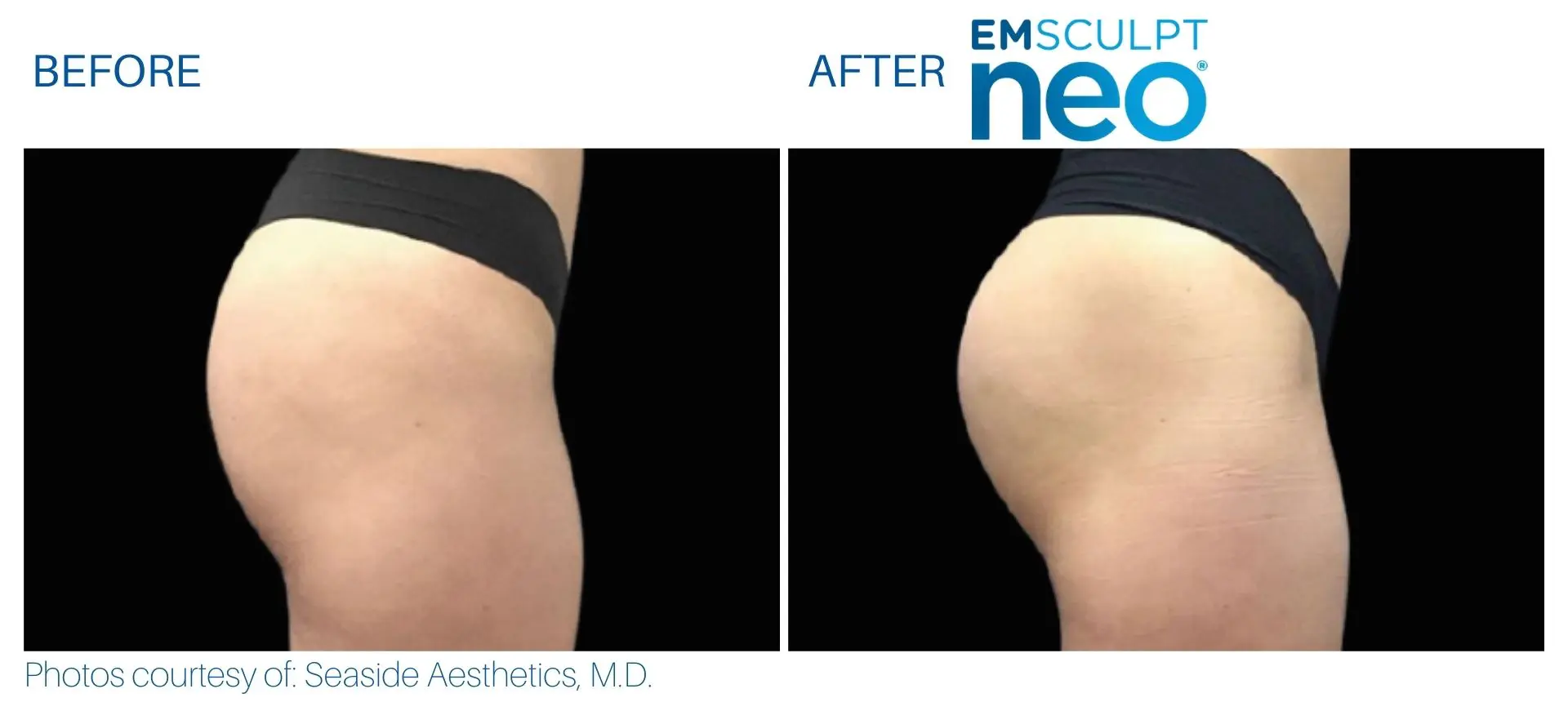 Emsculpt NEO for Thighs  Slim + Strengthen Your Legs