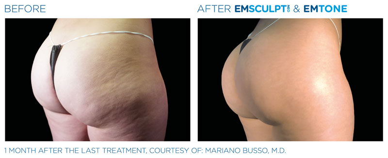 emsculpt neo benefits Reno NV