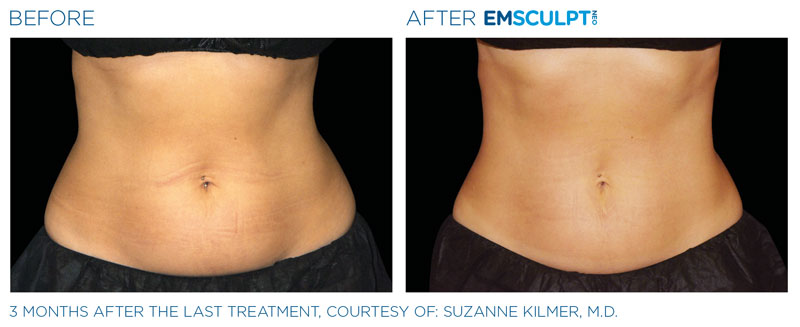 emsculpt neo benefits Reno NV