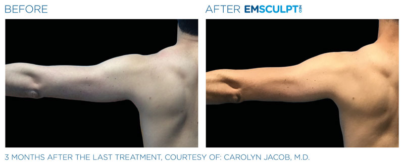 emsculpt neo benefits Reno NV